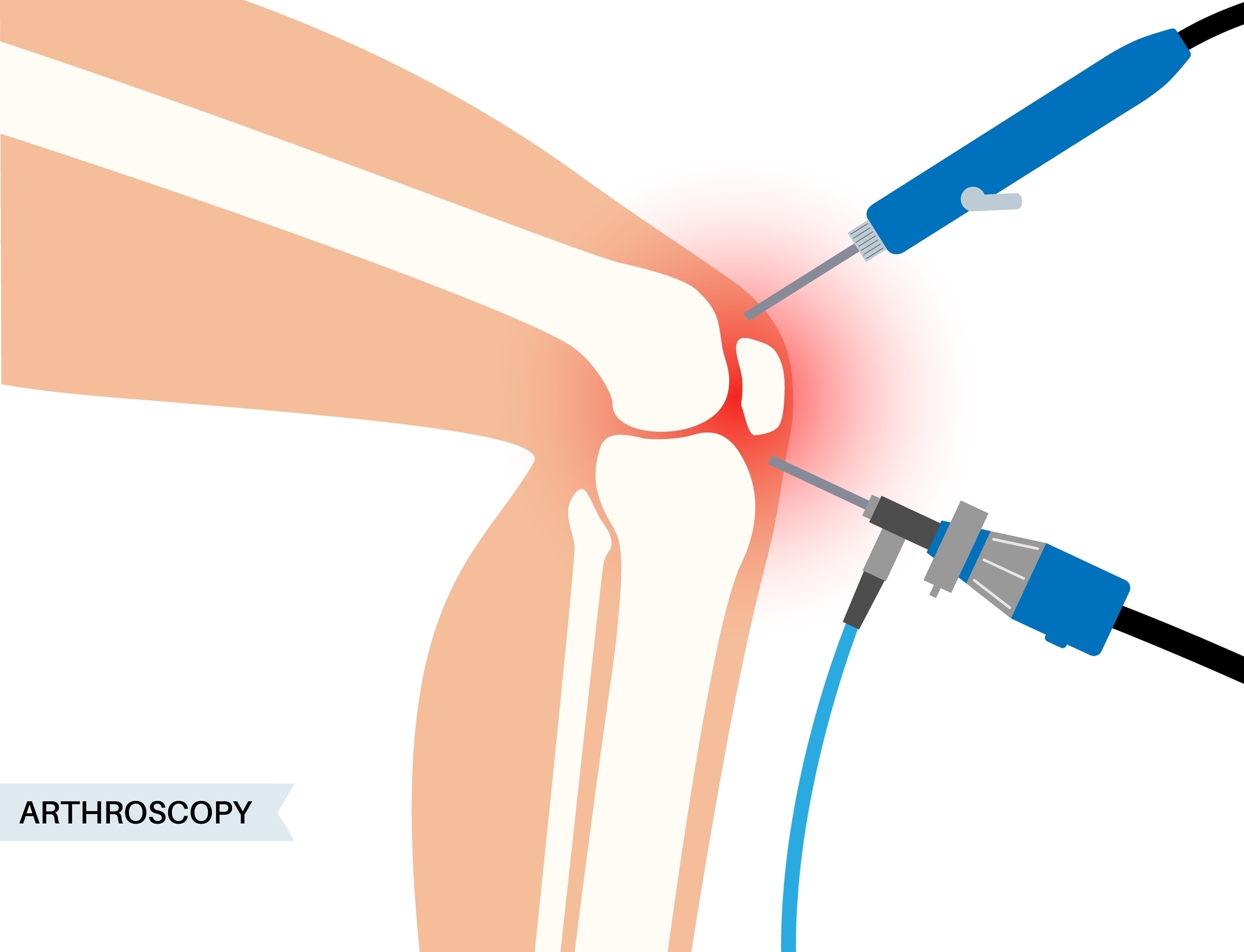 Αρθροσκόπηση γόνατος - δικηγορικό γραφείο θεσσαλονίκη