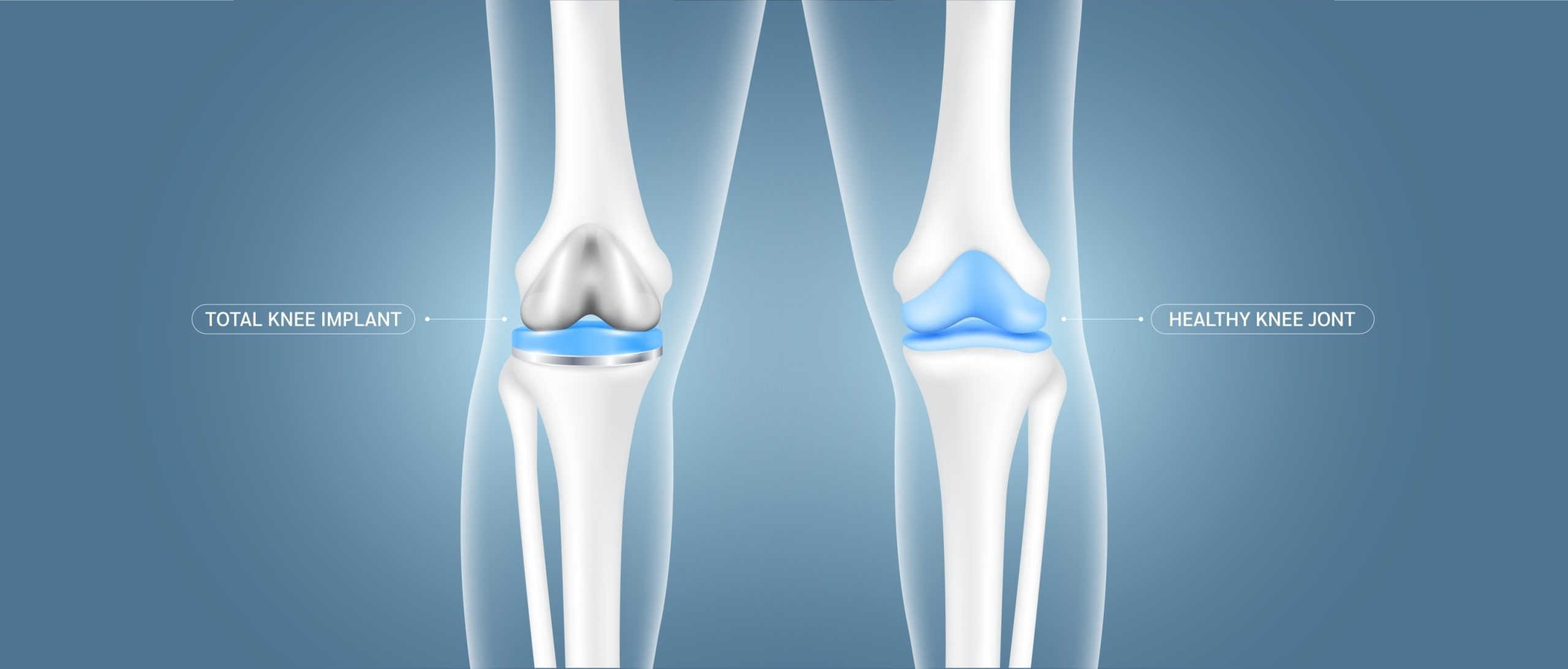 Αρθροπλαστική γόνατος - δικηγορικό γραφείο θεσσαλονίκη